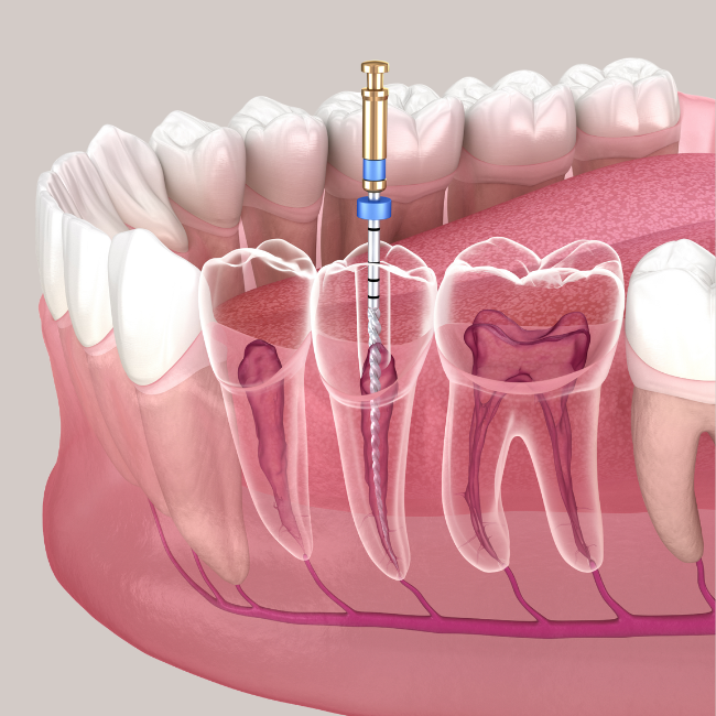 Root Canal