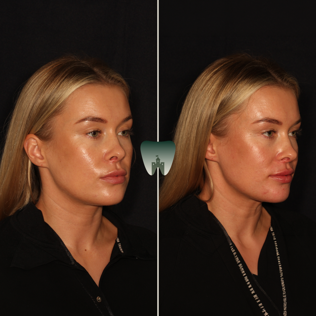 Cheek-Filler-Castle-1