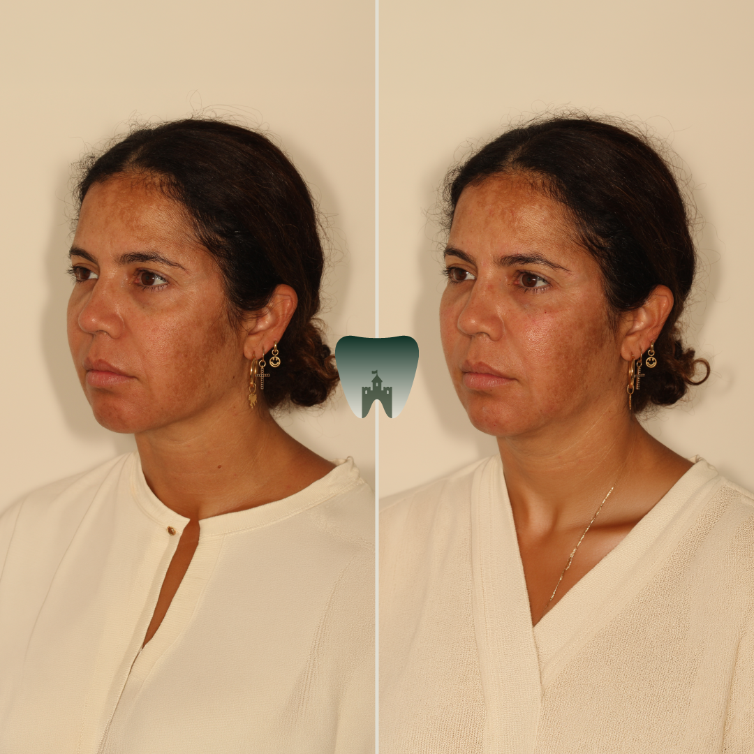 Cheek-Filler-Castle-2