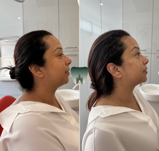 Chin-Filler-Castle-1