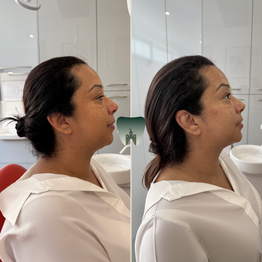 Chin-Filler-Castle-1