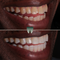 Composite-Bonding-Castle-MR2