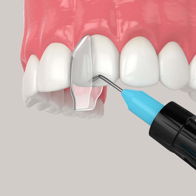 Composite Bonding