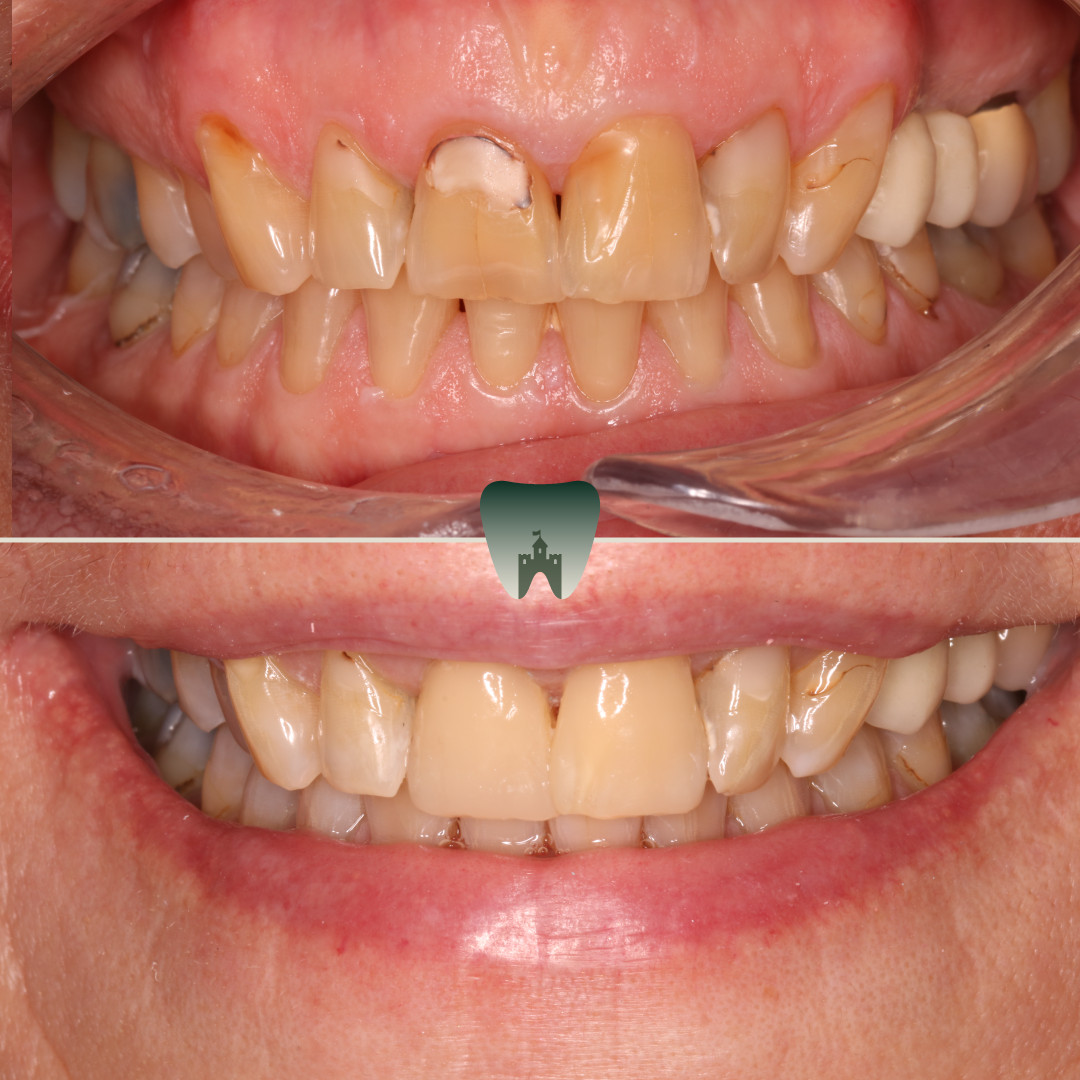 Composite-Veneers 1