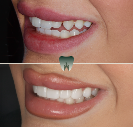 Composite-Veneers 2