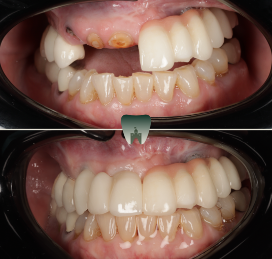 Implants (2)