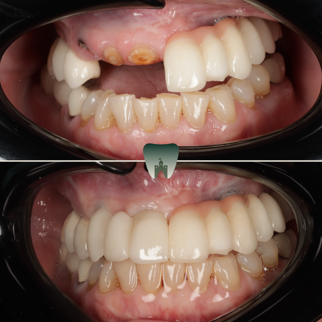 Implants (2)