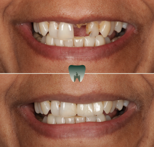 Implants (3)