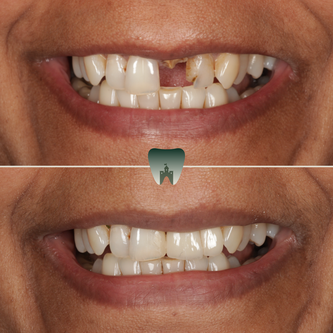 Implants (3)