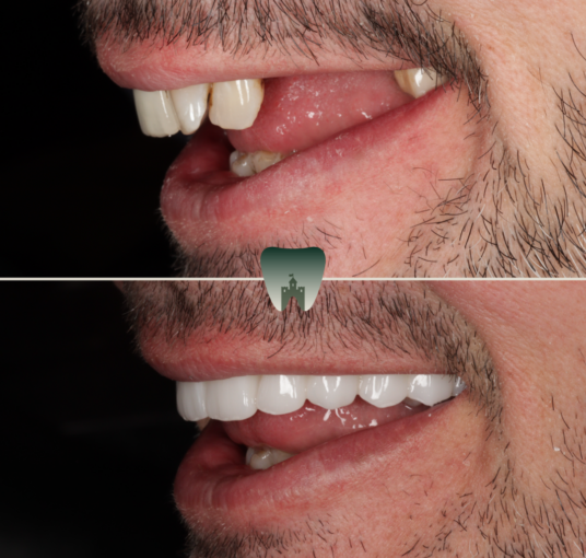 Implants (5)