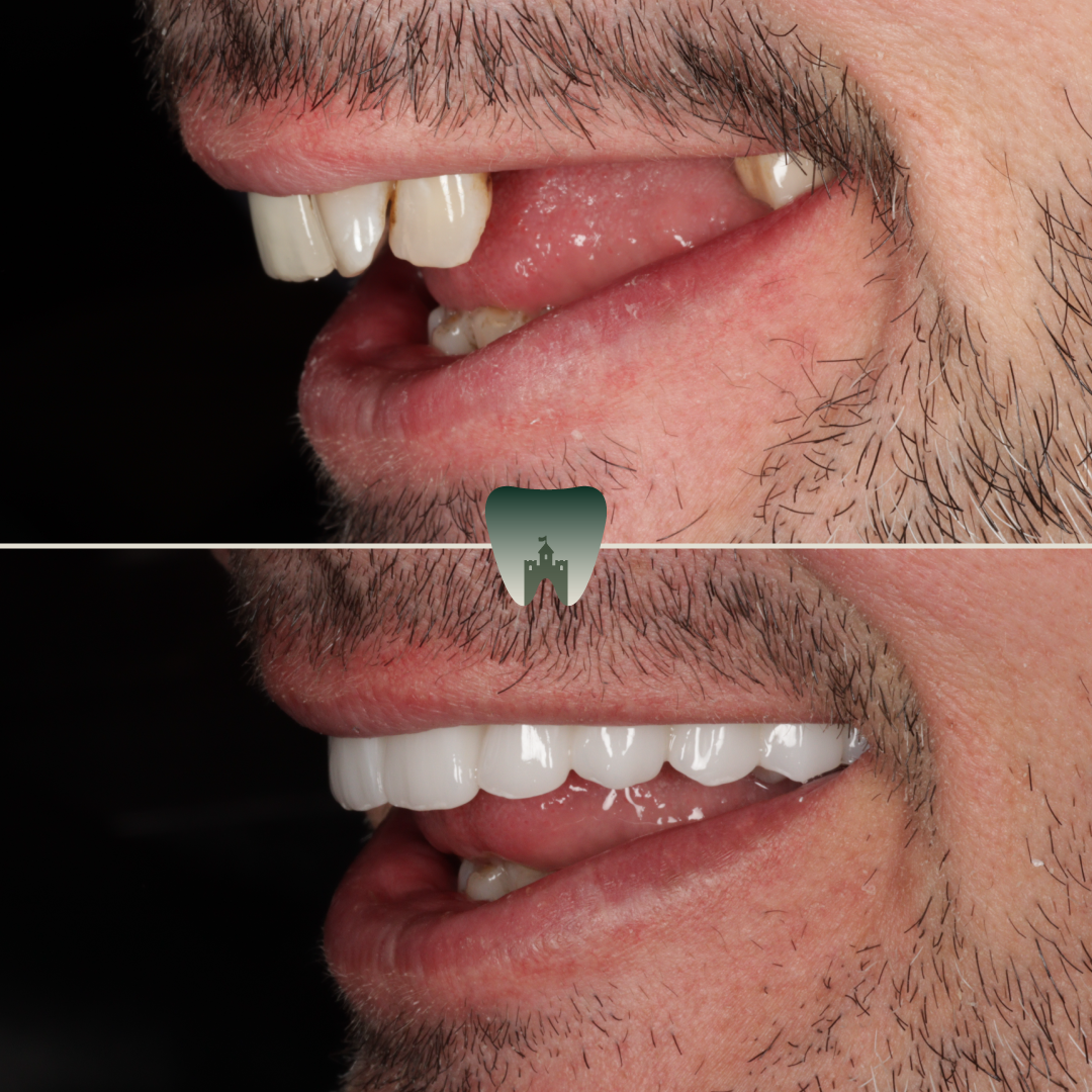 Implants (5)