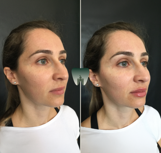 Lip-Filler-Castle-1