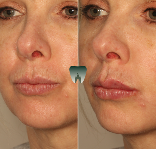 Lip-Hydration-Filler-Castle-1