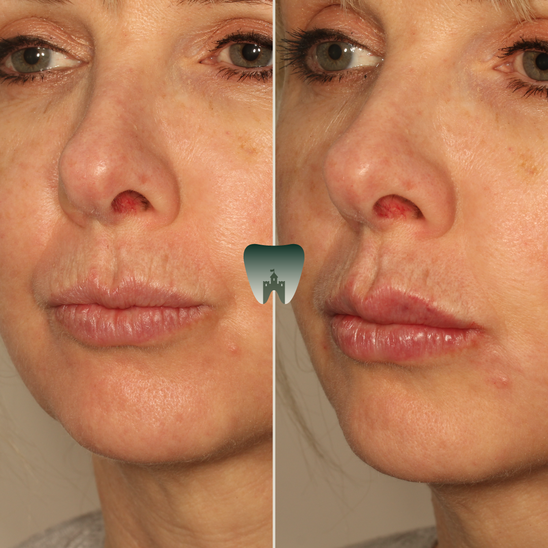 Lip-Hydration-Filler-Castle-1