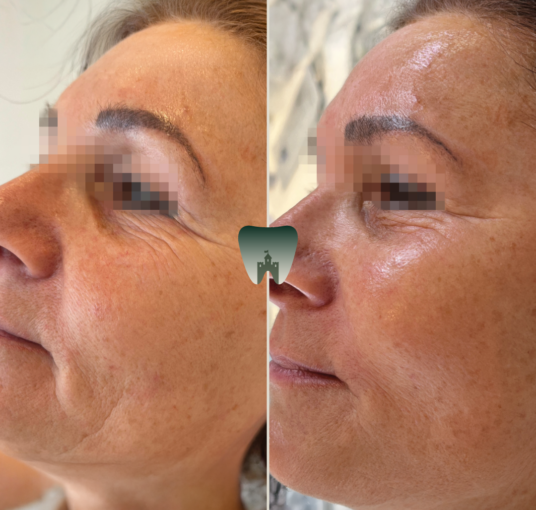Microneedling-Castle-1