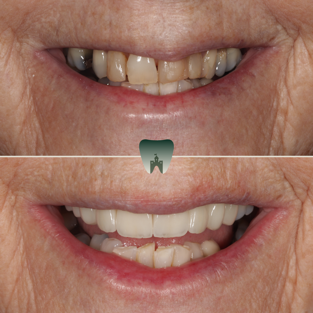 Porcelain-Veneers 3