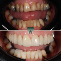 Porcelain-Veneers-4