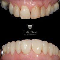 Porcelain-Veneers-5