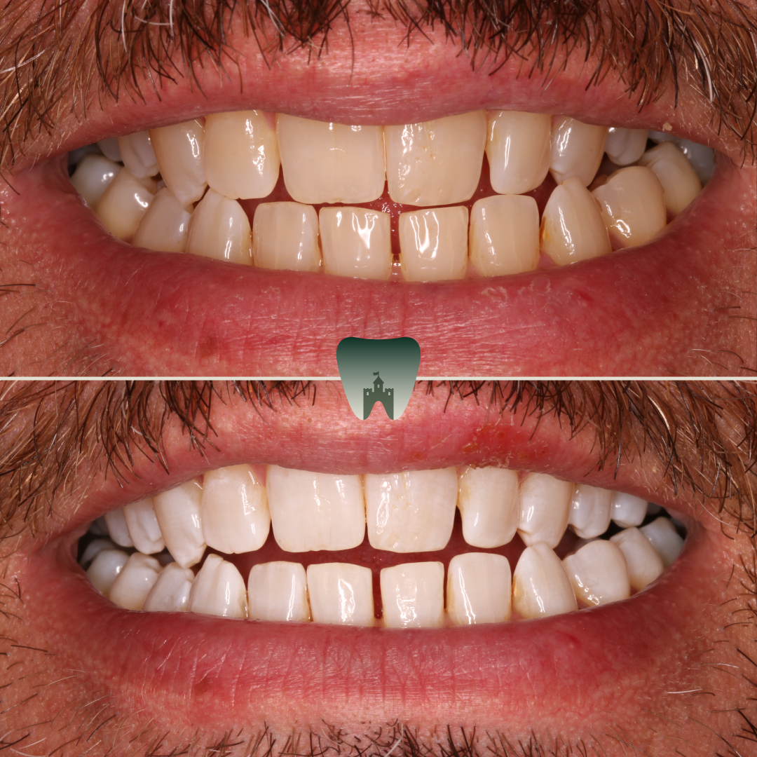 Whitening-7