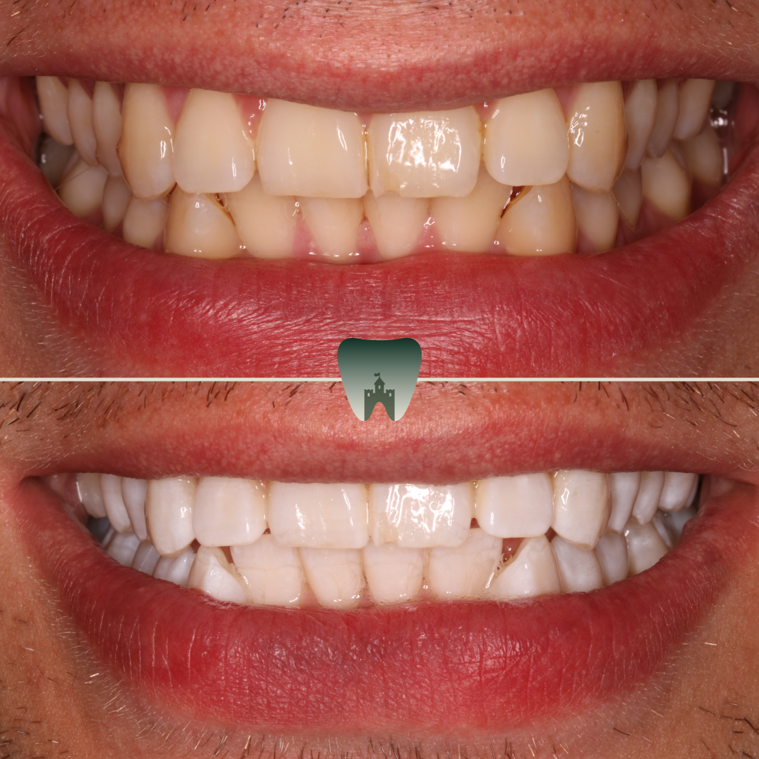 Whitening-8