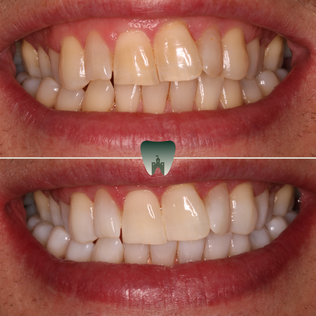 Whitening-1