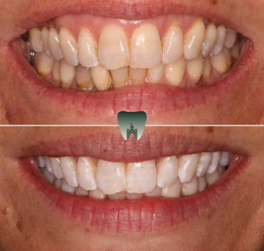 Whitening-2