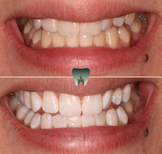 Whitening-3