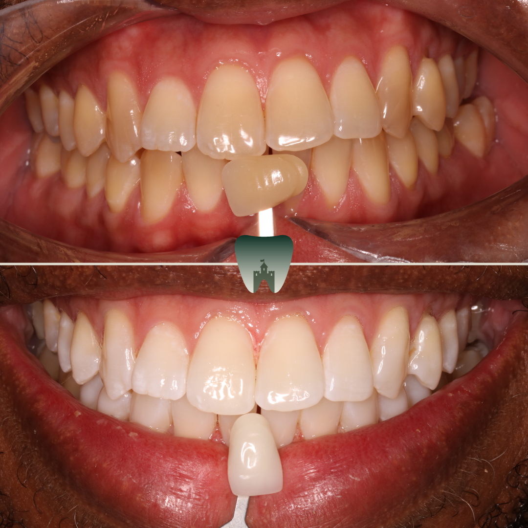 Whitening-4