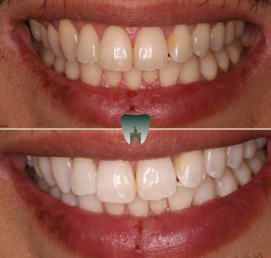 Whitening-5