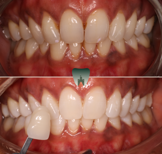 Whitening-6