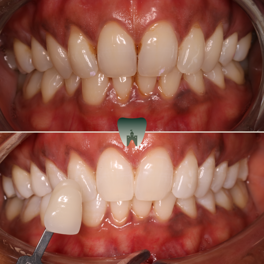Whitening-6